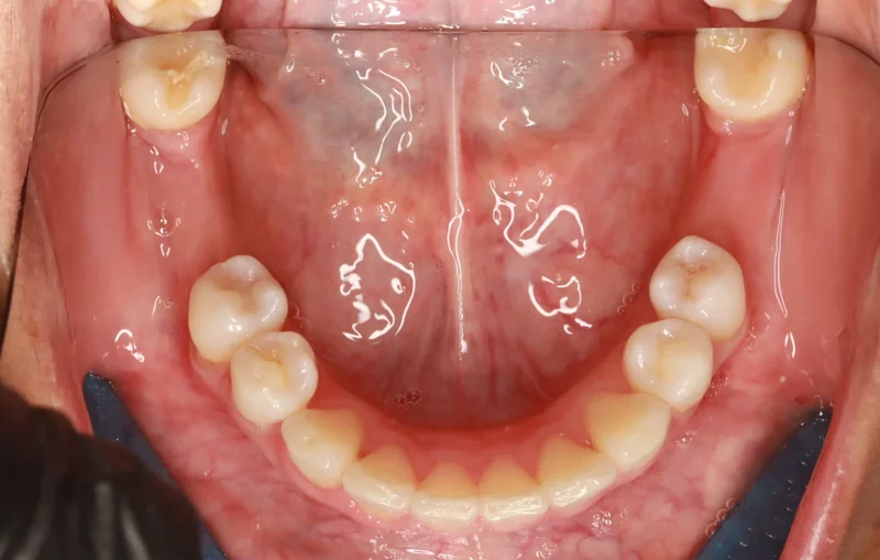 Lower - After Treatment