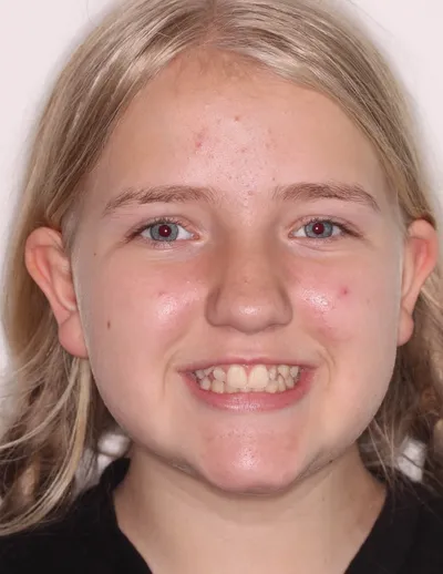 Before Metal Braces treatment - Case 102669