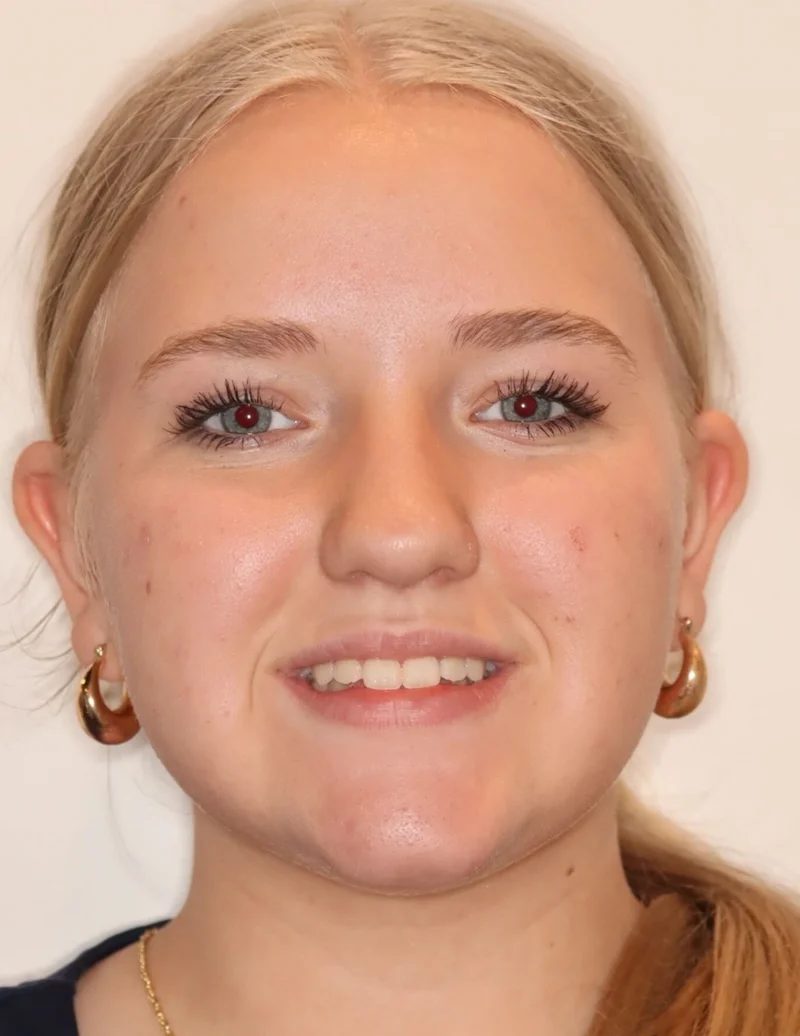 Facial Smiling - After Treatment
