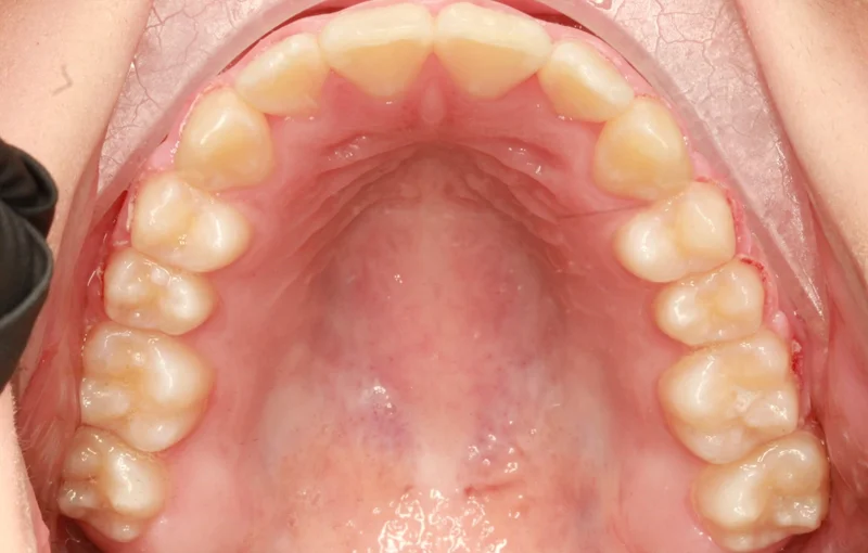 Upper - After Treatment