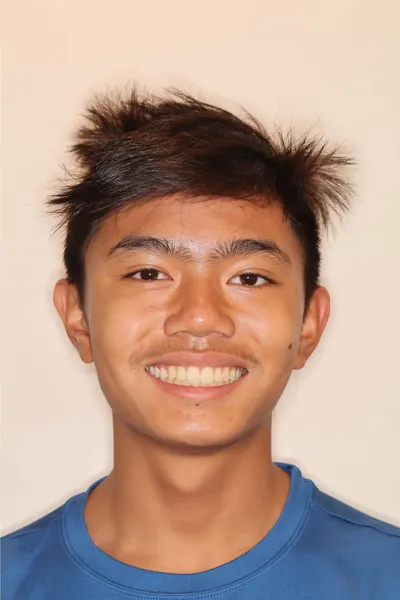 After Metal Braces treatment - Case 102686