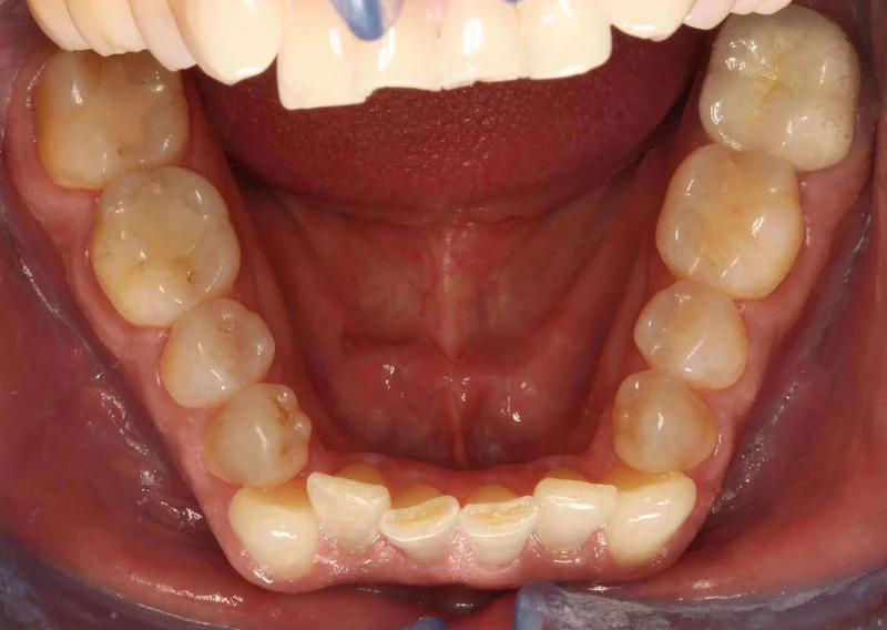 Lower Occlusal View - Before Treatment