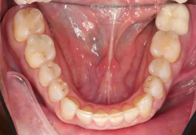 After Metal Braces treatment - Case 42526
