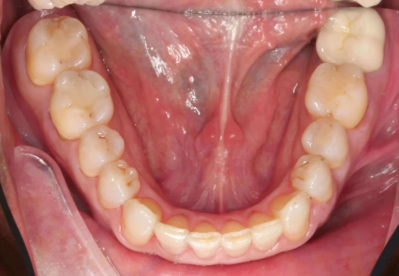 Lower Occlusal View - After Treatment