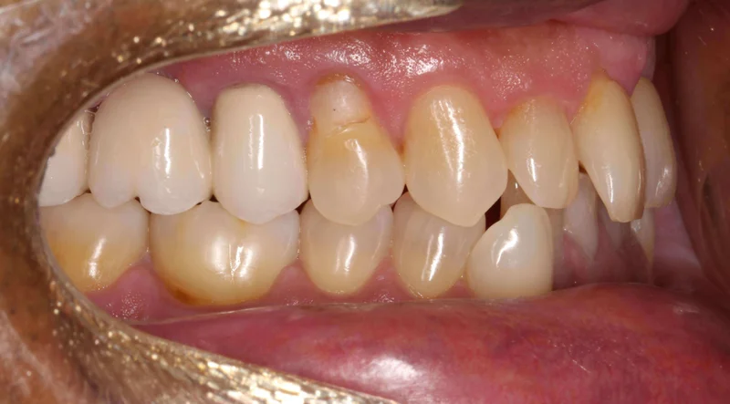 Right Buccal View - Before Treatment