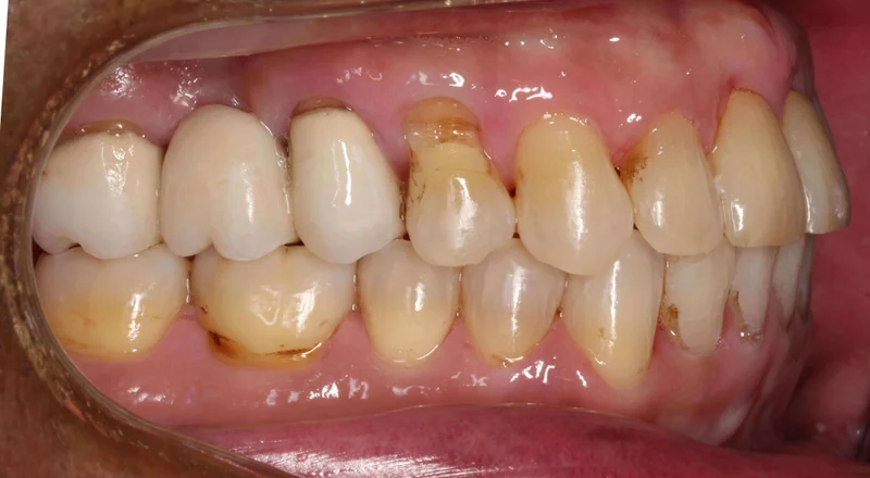 Right Buccal View - After Treatment