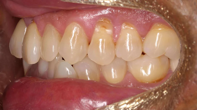 Left Buccal View - Before Treatment