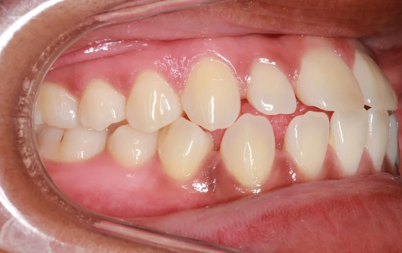 Right Buccal View - Before Treatment