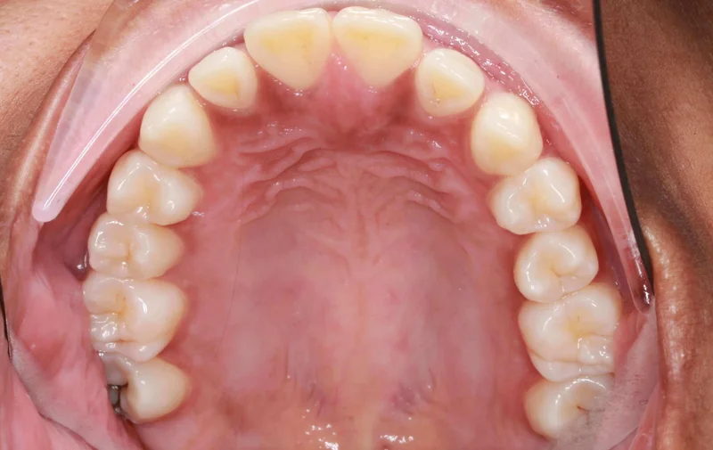 Upper Occlusal View - Before Treatment