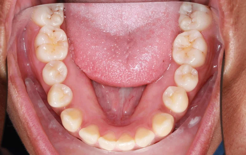 Lower Occlusal View - Before Treatment