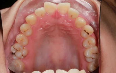 Before Metal Braces treatment - Case 42722