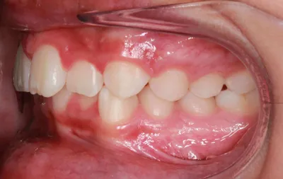 Before Metal Braces treatment - Case 42723