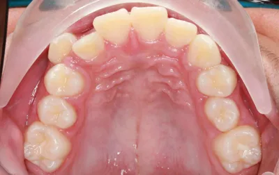 Before Metal Braces treatment - Case 47578