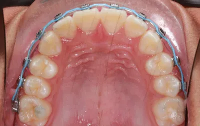 After Metal Braces treatment - Case 47578