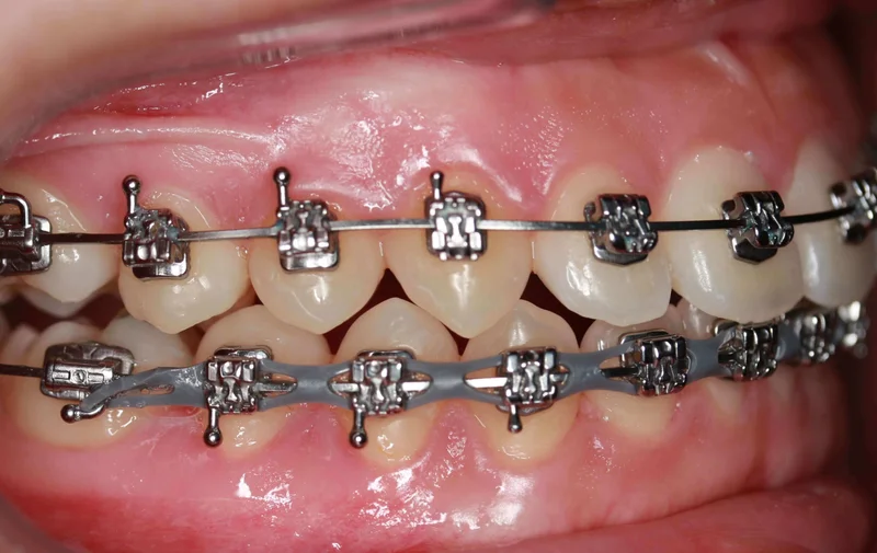 Right Buccal View - After Treatment