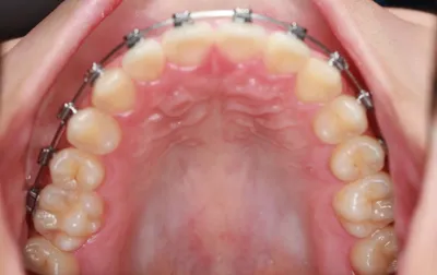 After Metal Braces treatment - Case 42722