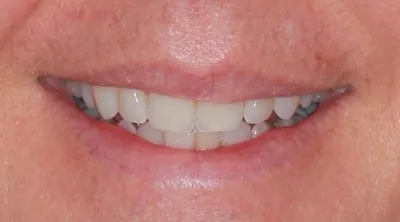 Before Metal Braces treatment - Case 51572