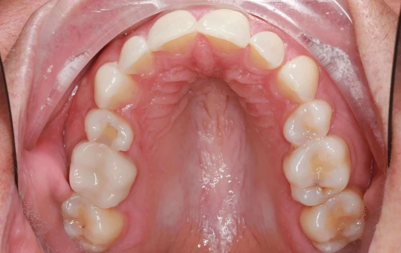 Upper View - Before Treatment