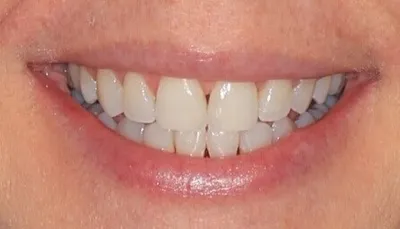 After Metal Braces treatment - Case 51572