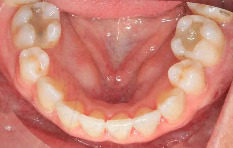 Lower View - After Treatment