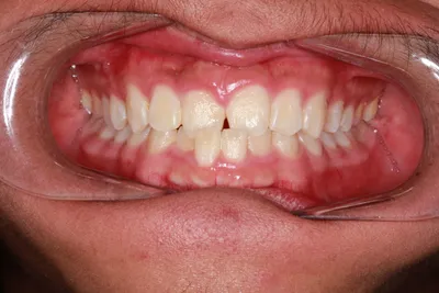 Before Metal Braces treatment - Case 51928