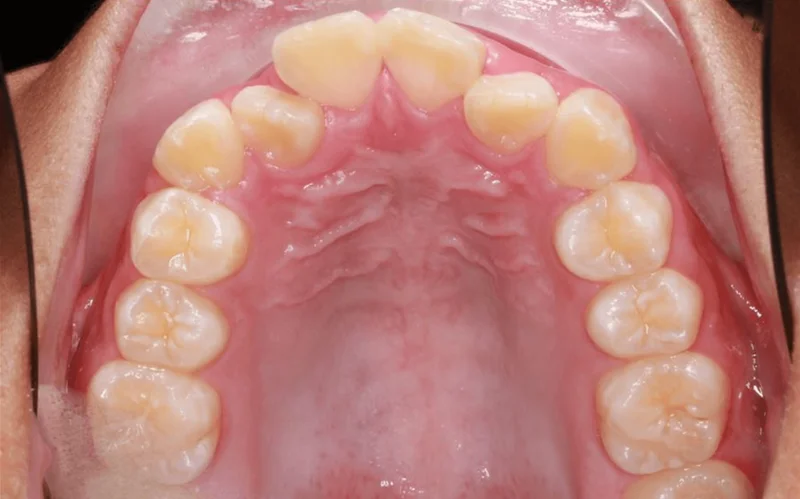 Upper Arch - Before Treatment