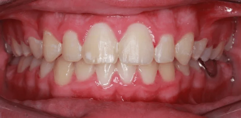 Center Bite - After Treatment