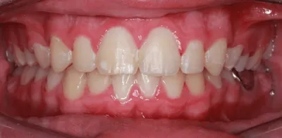 After Metal Braces treatment - Case 59665