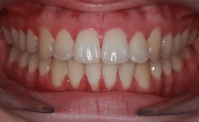 After Carriere Correction Appliance treatment - Case 59837