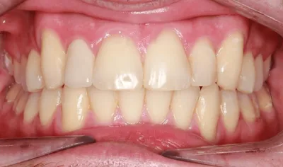 After Metal Braces treatment - Case 64535