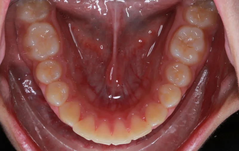 Lower Occlusal View - After Treatment