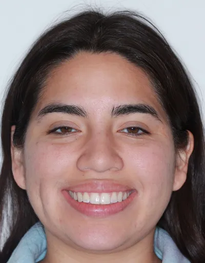 After Clear Braces treatment - Case 52581