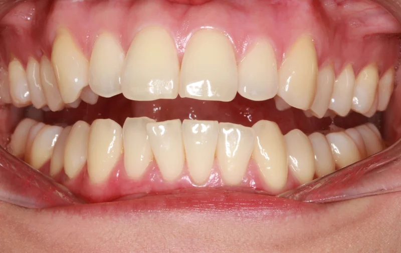 Center Open - Before Treatment