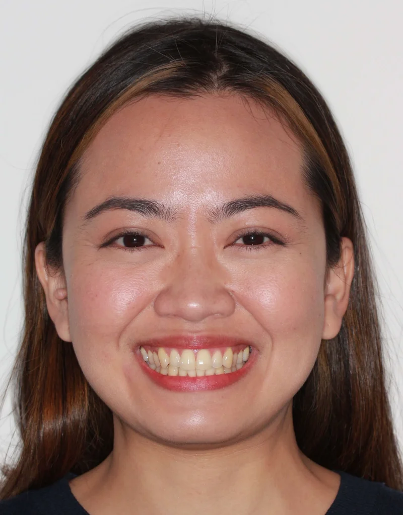 Smiling - Before Treatment