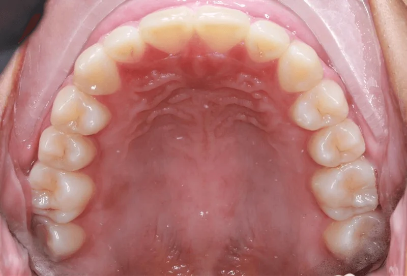 Upper Occlusal View - After Treatment
