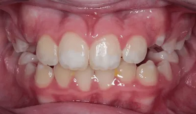 After Metal Braces treatment - Case 51927