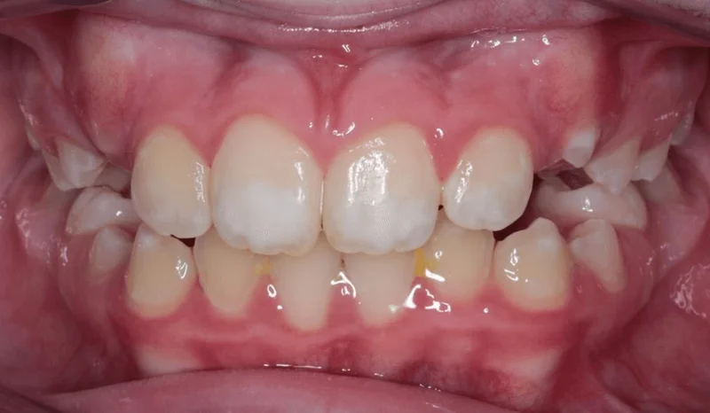 Center Bite - After Treatment