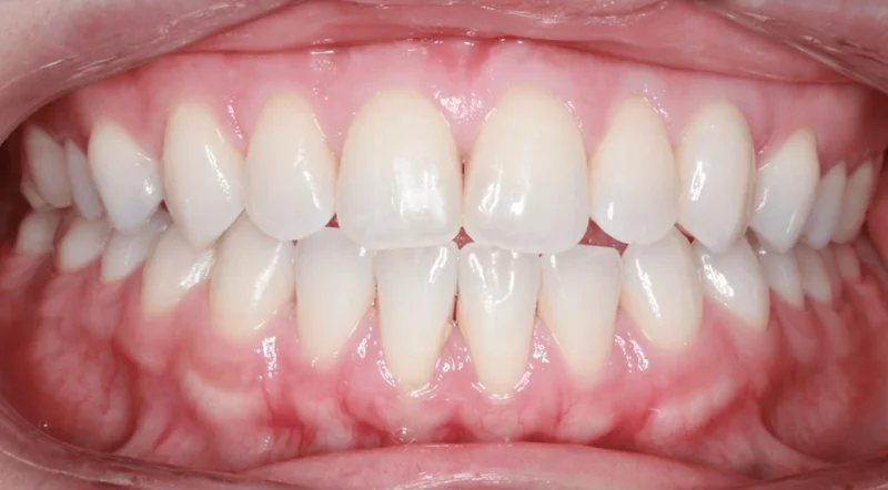 Center Bite - After Treatment