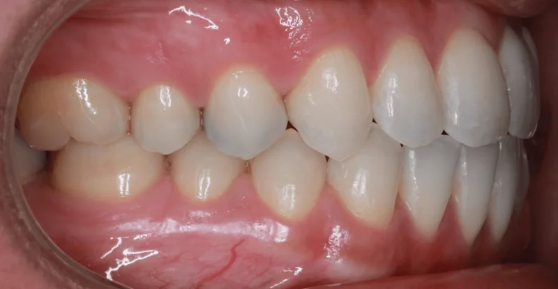 Right Side Bite - After Treatment