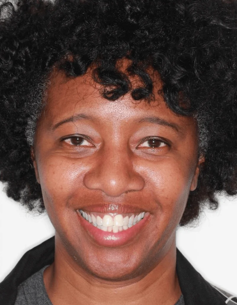 Smiling - Before Treatment