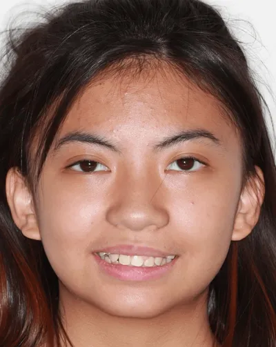 Before Metal Braces treatment - Case 68774