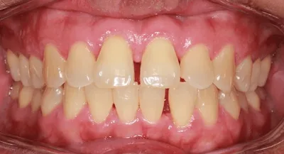 Before Metal Braces treatment - Case 72578