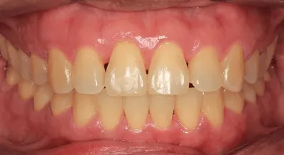 After Metal Braces treatment - Case 72578