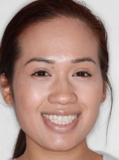 Before Metal Braces treatment - Case 71572