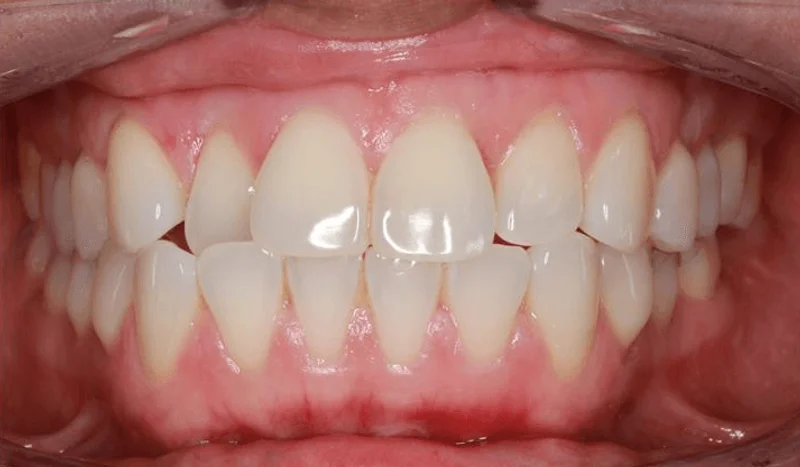 Center Bite - Before Treatment