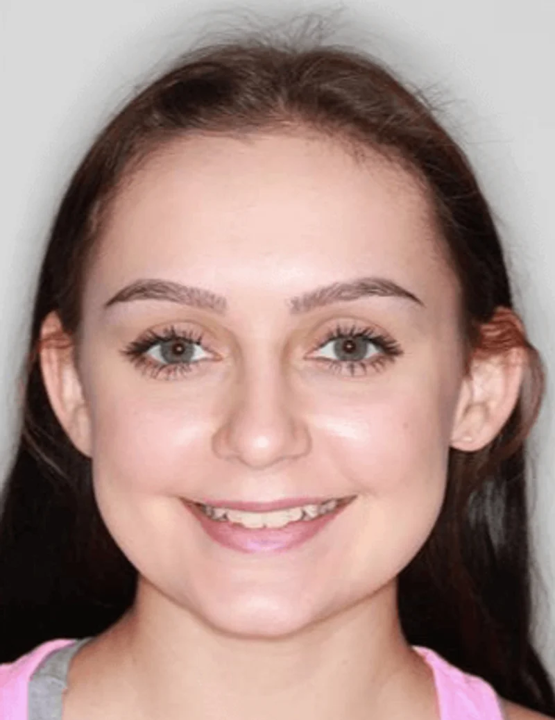 Facial Smiling - Before Treatment