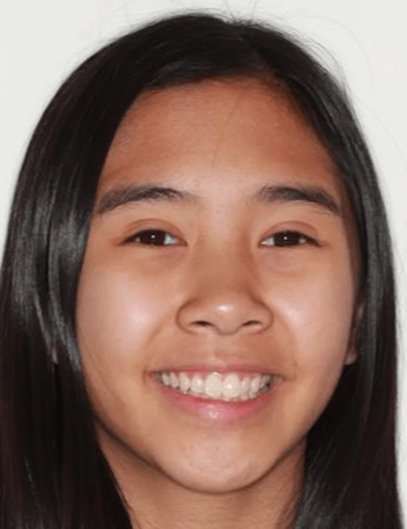 Facial Smiling - Before Treatment