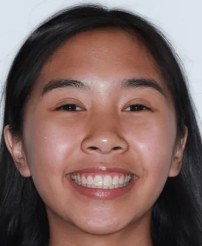 After Metal Braces treatment - Case 72591