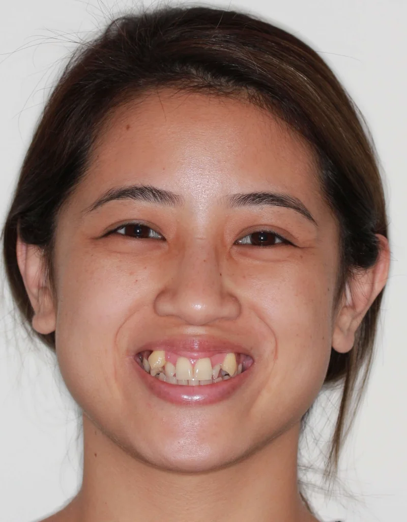 Facial Smiling - Before Treatment