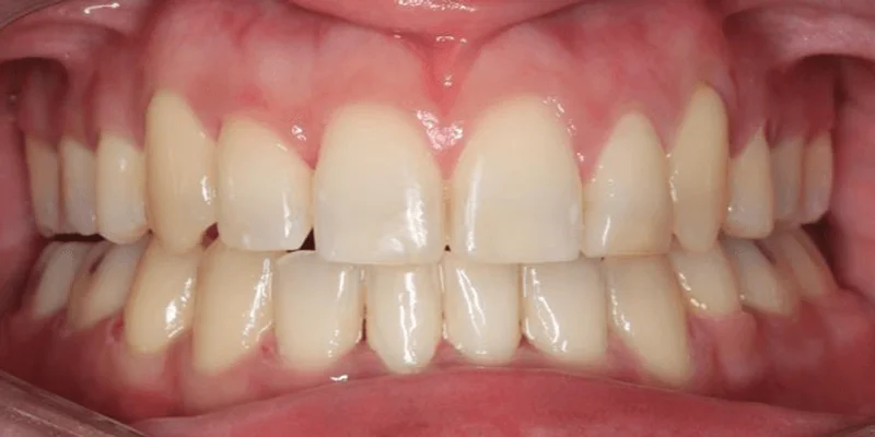 Center Bite - After Treatment
